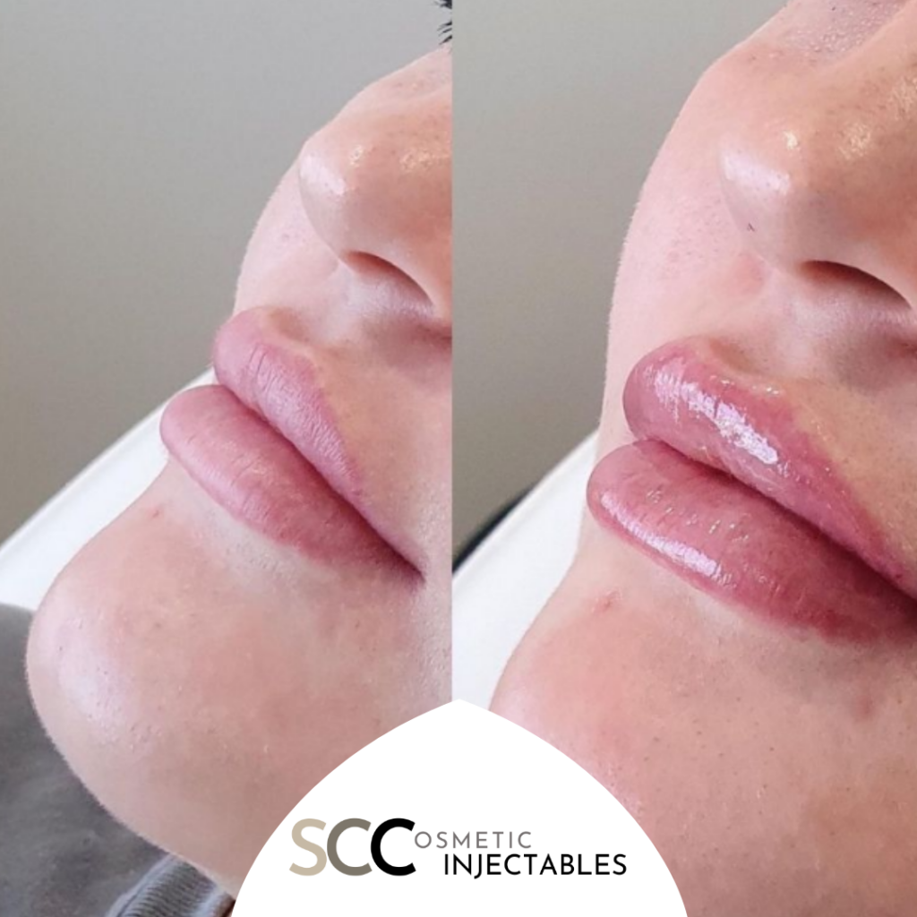 dermal fillers - scc injectables